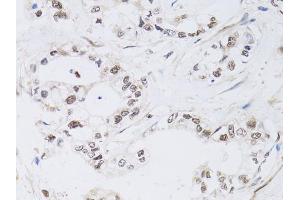 Immunohistochemistry of paraffin-embedded human gastric cancer using PAX3 antibody (ABIN6290725) at dilution of 1:100 (40x lens). (Paired Box 3 Antikörper)
