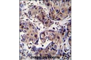 GEA3 Antibody (C-term) (ABIN390107 and ABIN2840619) immunohistochemistry analysis in forlin fixed and paraffin embedded hun breast carcino followed by peroxidase conjugation of the secondary antibody and DAB staining. (MAGEA3 Antikörper  (C-Term))