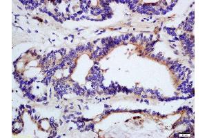 Formalin-fixed and paraffin embedded human colon cancer tissue labeled with Rabbit Anti-DHDH Polyclonal Antibody, Unconjugated (ABIN2559590) at 1:200 followed by conjugation to the secondary antibody and DAB staining (DHDH Antikörper  (AA 281-334))