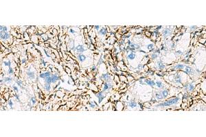 Immunohistochemistry of paraffin-embedded Human liver cancer tissue using ACTC1 Polyclonal Antibody at dilution of 1:55(x200) (ACTC1 Antikörper)