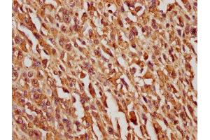 IHC image of ABIN7163445 diluted at 1:100 and staining in paraffin-embedded human melanoma cancer performed on a Leica BondTM system. (PEDF Antikörper  (AA 128-418))