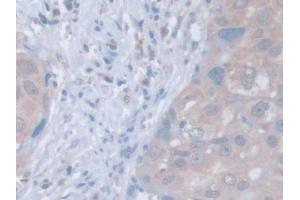 IHC-P analysis of Human Breast cancer Tissue, with DAB staining. (LDOC1 Antikörper  (AA 1-146))