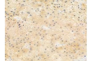 ABIN6257072 and ABIN6273592 at 1/100 staining human hepatocellular carcinoma by IHC-P. (CPEB1 Antikörper  (Internal Region))