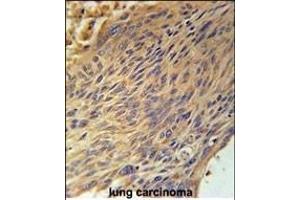 CPEB4 Antibody (N-term) (ABIN651815 and ABIN2840408) immunohistochemistry analysis in formalin fixed and paraffin embedded human lung carcinoma followed by peroxidase conjugation of the secondary antibody and DAB staining. (CPEB4 Antikörper  (N-Term))