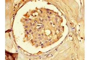 Immunohistochemistry of paraffin-embedded human breast cancer using ABIN7143311 at dilution of 1:100 (AHCY Antikörper  (AA 2-432))