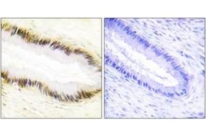 Immunohistochemistry analysis of paraffin-embedded human cervix carcinoma tissue, using NR2F6 Antibody. (NR2F6 Antikörper  (AA 11-60))