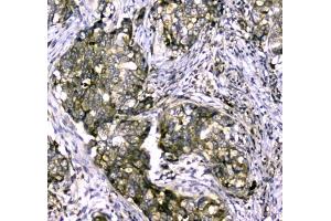 IHC testing of FFPE human breast cancer tissue with MYBPC3 antibody at 1ug/ml. (MYBPC3 Antikörper)