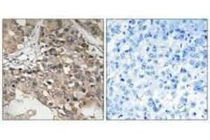 Immunohistochemistry analysis of paraffin-embedded human breast carcinoma tissue using MAP3K7 (Ab-187) antibody.
