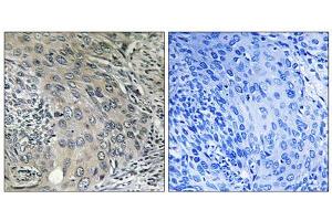 Immunohistochemistry analysis of paraffin-embedded human cervix carcinoma tissue using COPZ1 antibody. (COPZ1 Antikörper  (N-Term))