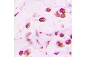 Immunohistochemical analysis of DLX5 staining in human lung cancer formalin fixed paraffin embedded tissue section. (DLX5 Antikörper  (Center))