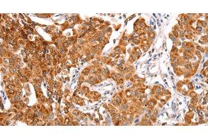 Immunohistochemistry of paraffin-embedded Human lung cancer using TRAF5 Polyclonal Antibody at dilution of 1:30 (TRAF5 Antikörper)