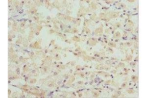 Immunohistochemistry of paraffin-embedded human gastric cancer using ABIN7162247 at dilution of 1:100 (OPA3 Antikörper  (AA 25-179))