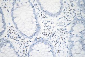Immunohistochemistry was performed on paraffin-embedded human sigmoid colon carcinoma using histone H3 (acetyl K23) antibody (ABIN7798950), 1:200).