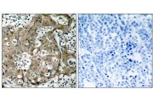 Immunohistochemical analysis of paraffin-embedded human breast carcinoma tissue using FKHR (Ab-319) antibody (E021161). (FOXO1 Antikörper)
