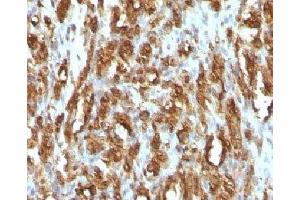 IHC testing of FFPE rhabdomyosarcoma with Muscle Actin antibody (Actin Antikörper)