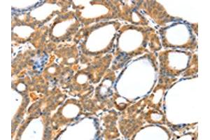 The image on the left is immunohistochemistry of paraffin-embedded Human thyroid cancer tissue using ABIN7130819(RASAL1 Antibody) at dilution 1/20, on the right is treated with fusion protein. (RASAL1 Antikörper)