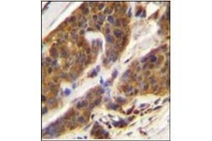 Immunohistochemistry analysis in Formalin Fixed, Paraffin Embedded Human bladder carcinoma stained with CFD Antibody (N-term) followed by peroxidase conjugation of the secondary antibody and DAB staining. (Adipsin Antikörper  (N-Term))