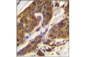 Immunohistochemistry analysis in Formalin Fixed, Paraffin Embedded Human bladder carcinoma stained with CFD Antibody (N-term) followed by peroxidase conjugation of the secondary antibody and DAB staining.