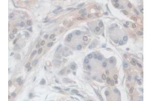 IHC-P analysis of Human Pancreatic cancer Tissue, with DAB staining. (VPS37A Antikörper  (AA 1-397))