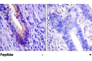 Immunohistochemical analysis of paraffin-embedded human colon carcinoma tissue using EIF4G1 polyclonal antibody . (EIF4G1 Antikörper)