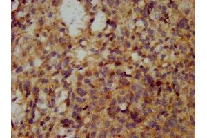 IHC image of ABIN7175671 diluted at 1:200 and staining in paraffin-embedded human ovarian cancer performed on a Leica BondTM system. (WFDC2 Antikörper  (AA 31-124))