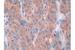 IHC-P analysis of Human Liver cancer Tissue, with DAB staining. (CUBN Antikörper  (AA 3511-3623))