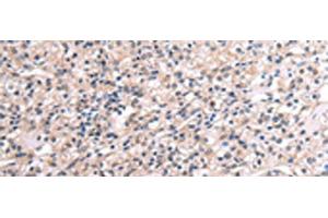 Immunohistochemistry of paraffin-embedded Human liver cancer tissue using RNF115 Polyclonal Antibody at dilution of 1:45(x200) (RNF115 Antikörper)