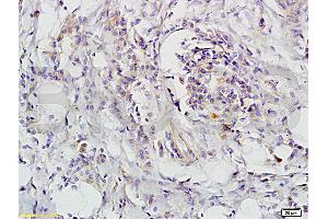 Formalin-fixed and paraffin-embedded human colon carcinoma labeled with Rabbit Anti-CD118 Polyclonal Antibody, unconjugated  (ABIN686827)  1: 200 followed by incubation with conjugated secondary antibody and DAB staining (LIFR Antikörper  (AA 451-580))