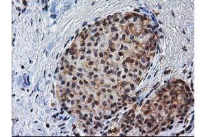 Immunohistochemical staining of paraffin-embedded Adenocarcinoma of Human breast tissue using anti-NHEJ1 mouse monoclonal antibody. (NHEJ1 Antikörper)
