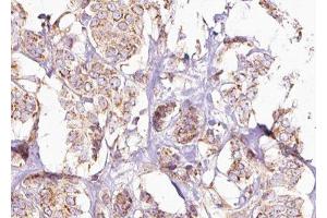 ABIN6275245 at 1/100 staining Human breast cancer tissue by IHC-P. (MRPL49 Antikörper  (Internal Region))