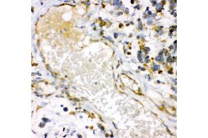 Anti- HMOX1 antibody, IHC(P) IHC(P): Human Lung Cancer Tissue