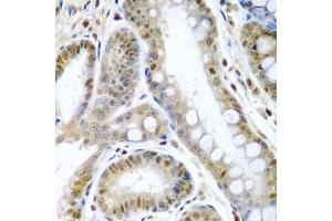 Immunohistochemistry of paraffin-embedded human colon carcinoma using TNFSF10 antibody (ABIN3023014, ABIN3023015, ABIN3023016 and ABIN6219347) at dilution of 1:200 (40x lens). (TRAIL Antikörper  (AA 39-250))