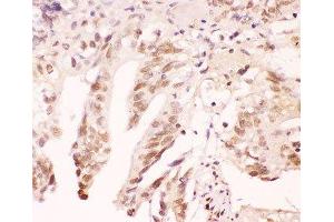 IHC-P: ATF1 antibody testing of human intestinal cancer tissue (AFT1 Antikörper  (AA 1-271))