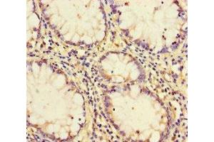 Immunohistochemistry of paraffin-embedded human colon cancer using ABIN7164149 at dilution of 1:100 (PCF11 Antikörper  (AA 409-604))