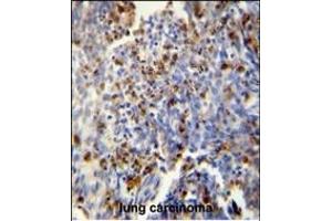 FOSL2 antibody (Center) (ABIN654925 and ABIN2844568) immunohistochemistry analysis in formalin fixed and paraffin embedded human lung carcinoma followed by peroxidase conjugation of the secondary antibody and DAB staining. (FOSL2 Antikörper  (AA 95-122))