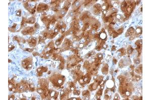 Formalin-fixed, paraffin-embedded human Hepatocellular Carcinoma stained with Serum Amyloid A Mouse Monoclonal Antibody (SAA/326).