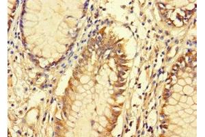 Immunohistochemistry of paraffin-embedded human colon cancer using ABIN7165398 at dilution of 1:100 (FAM135B Antikörper  (AA 801-1100))
