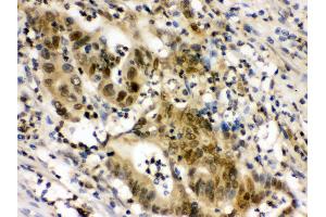 Anti- EIF6 Picoband antibody,IHC(P) IHC(P): Human Intestinal Cancer Tissue (EIF6 Antikörper  (AA 66-210))