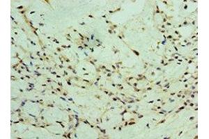 Immunohistochemistry of paraffin-embedded human breast cancer using ABIN7176056 at dilution of 1:100 (ZEB2 Antikörper  (AA 1050-1214))