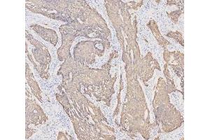 IHC analysis of Cytokeratin 19 using anti-Cytokeratin 19 antibody (ABIN3043288).
