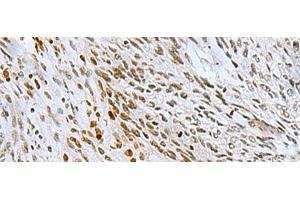 Immunohistochemistry of paraffin-embedded Human lung cancer tissue using CNOT7 Polyclonal Antibody at dilution of 1:55(x200) (CNOT7 Antikörper)