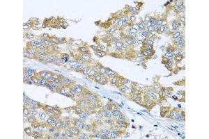 Immunohistochemistry of paraffin-embedded Human liver cancer using COQ7 Polyclonal Antibody at dilution of 1:100 (40x lens). (Coq7 Antikörper)