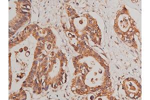 ABIN6268758 at 1/50 staining human colon cancer tissue sections by IHC-P. (CYP17A1 Antikörper  (Internal Region))