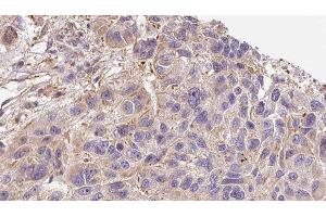 ABIN6276397 at 1/100 staining Human Melanoma tissue by IHC-P. (Interleukin 17a Antikörper  (Internal Region))