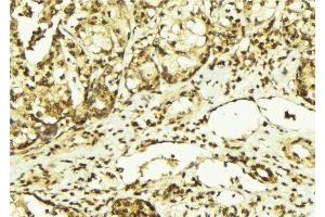 ABIN6267569 at 1/100 staining Human breast cancer tissue by IHC-P. (PRKDC Antikörper  (pThr2647))
