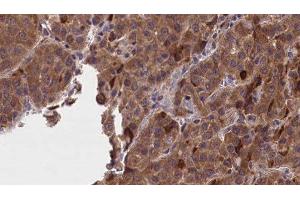 ABIN6277234 at 1/100 staining Human liver cancer tissue by IHC-P. (GNAO1 Antikörper  (Internal Region))