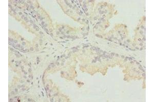 Immunohistochemistry of paraffin-embedded human prostate cancer using ABIN7158931 at dilution of 1:100