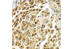 Immunohistochemistry of paraffin-embedded human liver cancer using SND1 antibody. (SND1 Antikörper)