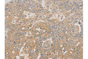 The image on the left is immunohistochemistry of paraffin-embedded Human breast cancer tissue using ABIN7130971(SCAP Antibody) at dilution 1/20, on the right is treated with fusion protein. (SREBF chaperone Antikörper)