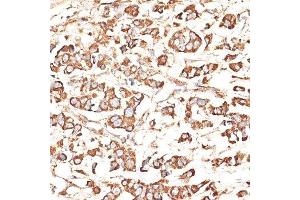 Immunohistochemistry of paraffin-embedded human mammary cancer using KIR3DS1 antibody. (KIR3DS1 Antikörper  (AA 80-340))